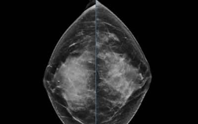 Caso 4: Radiología de mama