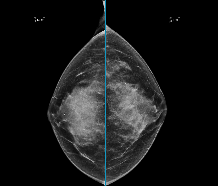 Caso 4: Radiología de mama