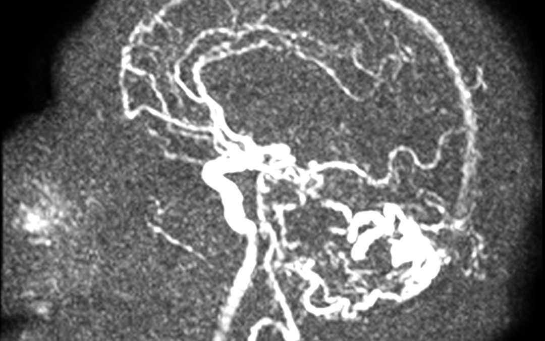 Caso de neurorradiología